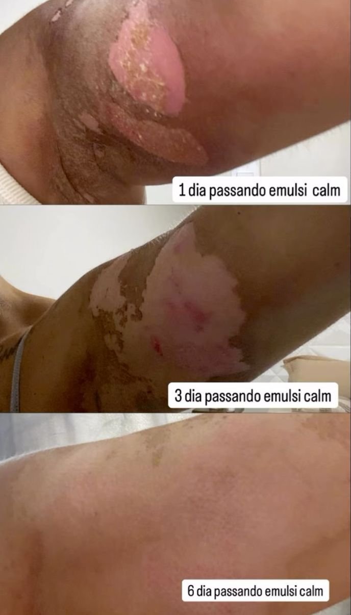 Evolução de queimadura na axila e braço — 1º, 3º e 6º dia passando Emulsicalm
