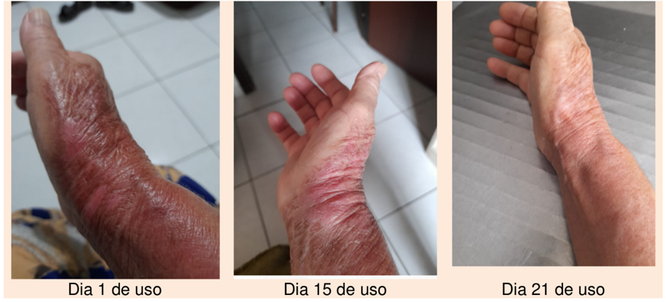 Evolução de queimadura na mão e antebraço — dia 1, dia 15 e dia 21 de uso do creme Emulsicalm